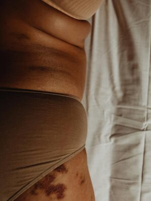 A detailed shot focusing on a woman's body, highlighting natural folds and bruises in a realistic setting.