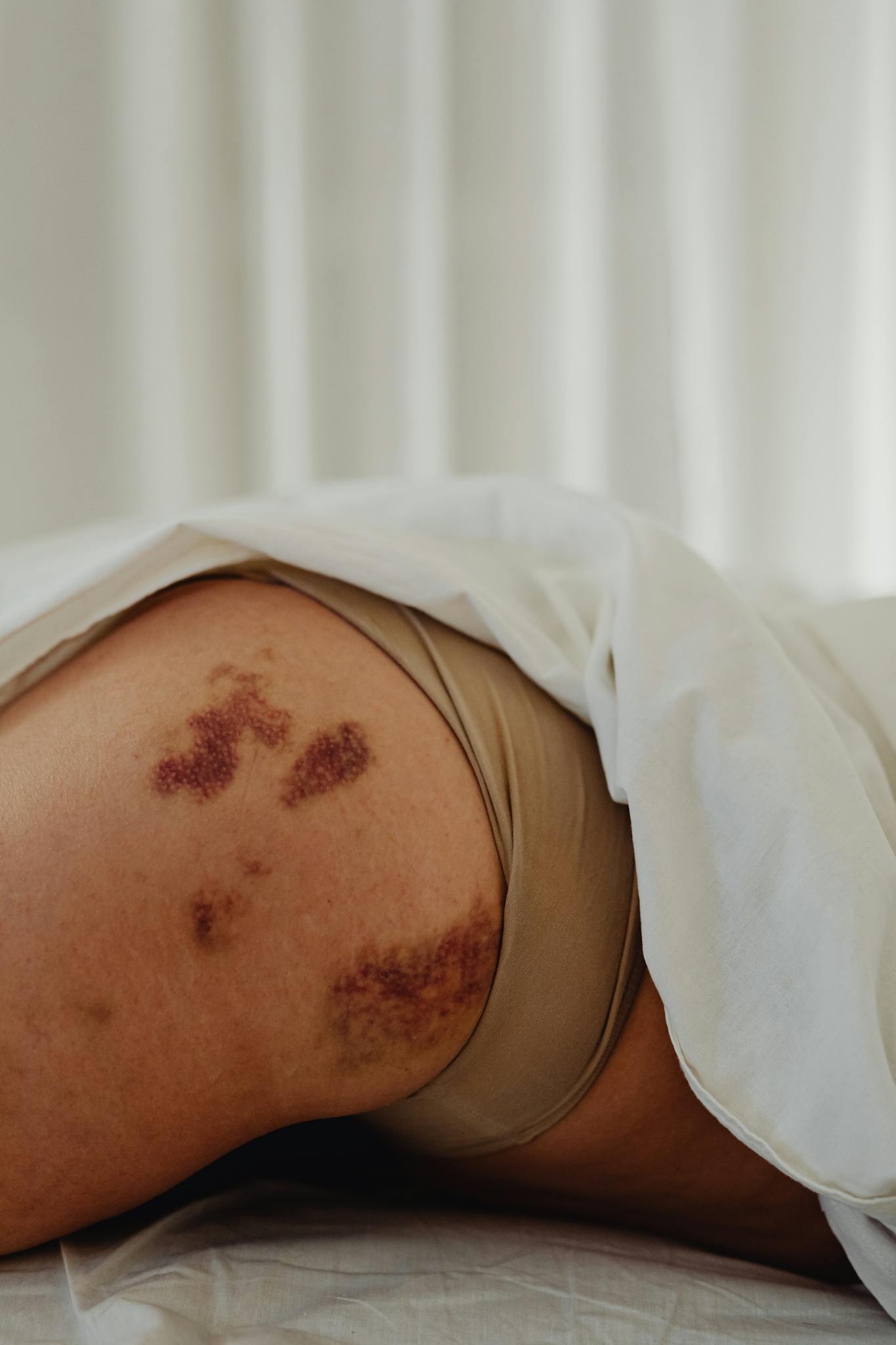 Intimate close-up of a woman's bruised skin, highlighting imperfection.